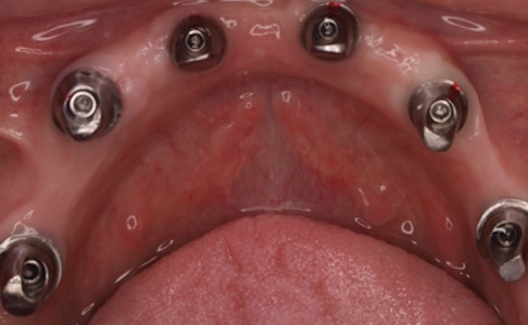 caso-real-implantes-y-cirugia-avanzada2