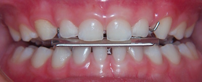 rehabilitacion-neruo-oclusal2