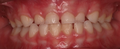 rehabilitacion-neruo-oclusal5