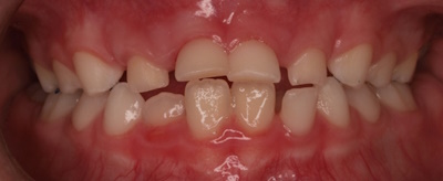 rehabilitacion-neruo-oclusal6