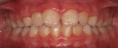 rehabilitacion-neruo-oclusal9